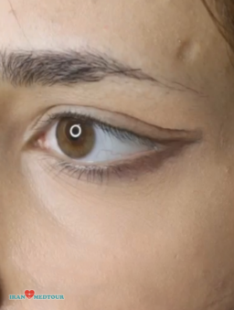 cat eyes surgery canthoplasty fox eyes