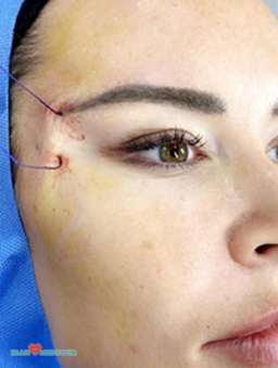 cat eyes surgery canthoplasty fox eyes