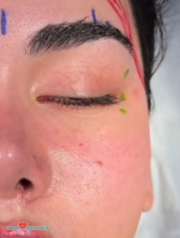 cat eyes surgery canthoplasty fox eyes