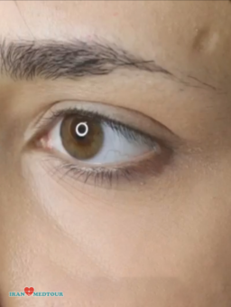 cat eyes surgery canthoplasty fox eyes