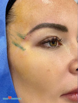 cat eyes surgery canthoplasty fox eyes