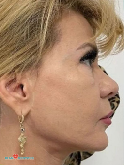 facelift surgery before and after