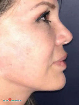 facelift surgery before and after