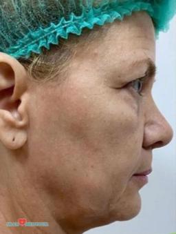 facelift surgery before and after