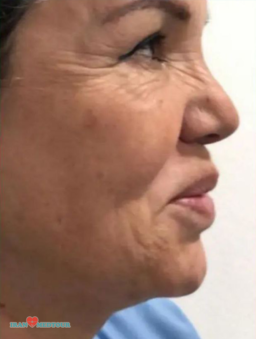 facelift surgery before and after