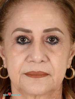 facelift surgery before and after