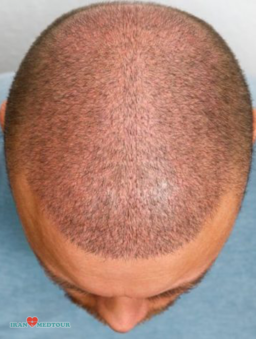 hair transplant before and after