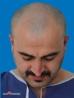 hair transplant before and after