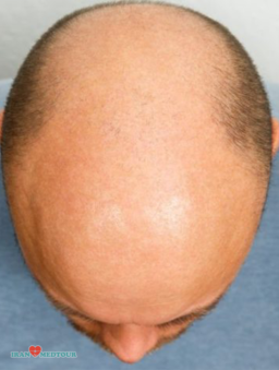 hair transplant before and after