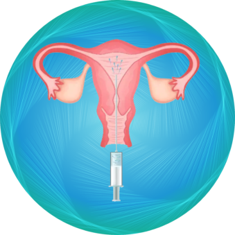 Intrauterine insemination iui