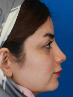 rhinoplasty before and after
