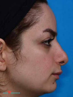 rhinoplasty before and after