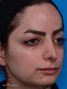 rhinoplasty before and after