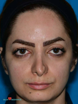 rhinoplasty before and after