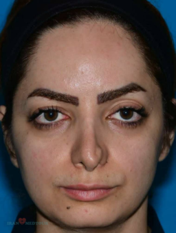 rhinoplasty before and after